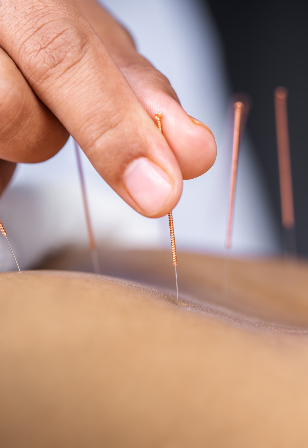 Massage therapist doing dry needling acupuncture